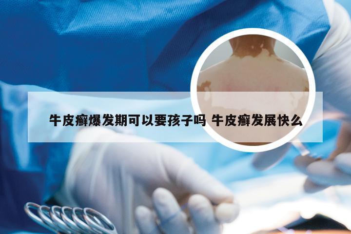牛皮癣爆发期可以要孩子吗 牛皮癣发展快么