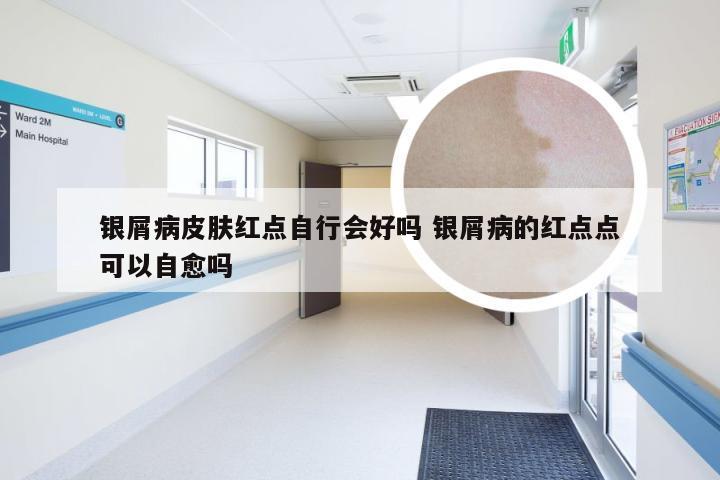 银屑病皮肤红点自行会好吗 银屑病的红点点可以自愈吗