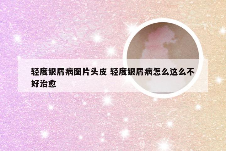 轻度银屑病图片头皮 轻度银屑病怎么这么不好治愈