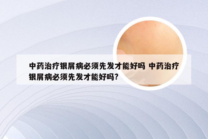 中药治疗银屑病必须先发才能好吗 中药治疗银屑病必须先发才能好吗?