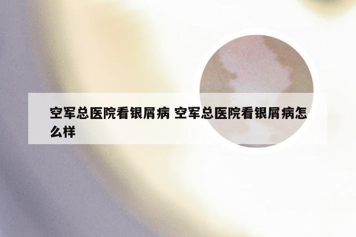 空军总医院看银屑病 空军总医院看银屑病怎么样