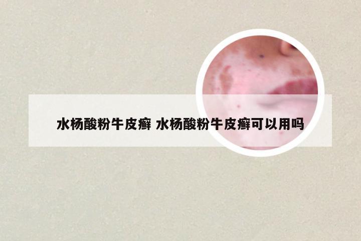 水杨酸粉牛皮癣 水杨酸粉牛皮癣可以用吗