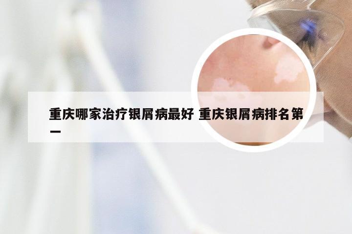 重庆哪家治疗银屑病最好 重庆银屑病排名第一