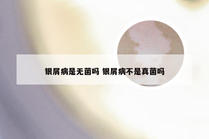 银屑病是无菌吗 银屑病不是真菌吗