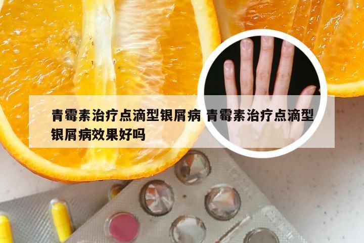 青霉素治疗点滴型银屑病 青霉素治疗点滴型银屑病效果好吗