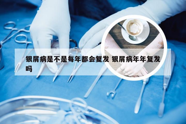 银屑病是不是每年都会复发 银屑病年年复发吗