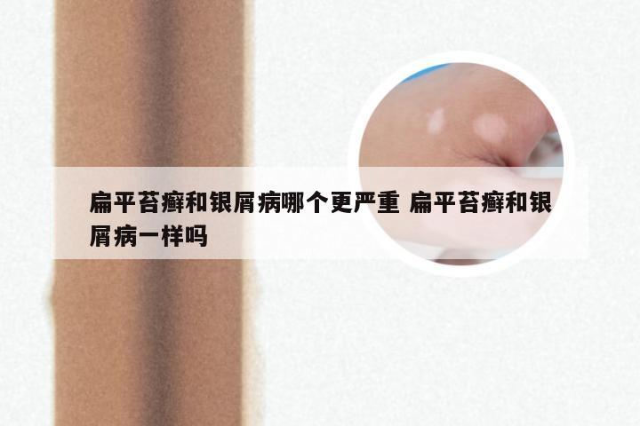 扁平苔癣和银屑病哪个更严重 扁平苔癣和银屑病一样吗