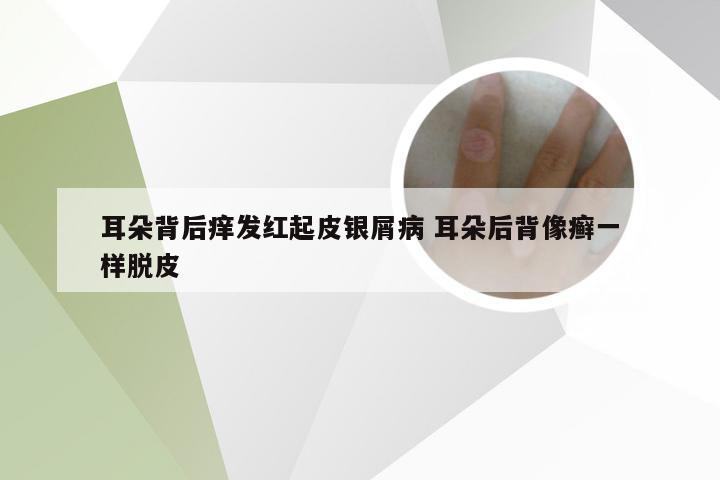 耳朵背后痒发红起皮银屑病 耳朵后背像癣一样脱皮
