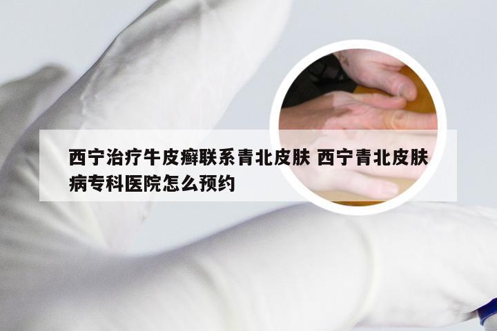 西宁治疗牛皮癣联系青北皮肤 西宁青北皮肤病专科医院怎么预约