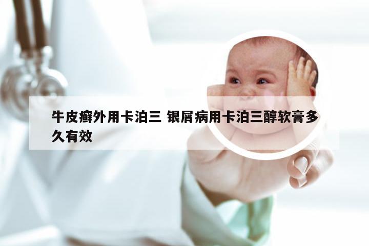 牛皮癣外用卡泊三 银屑病用卡泊三醇软膏多久有效