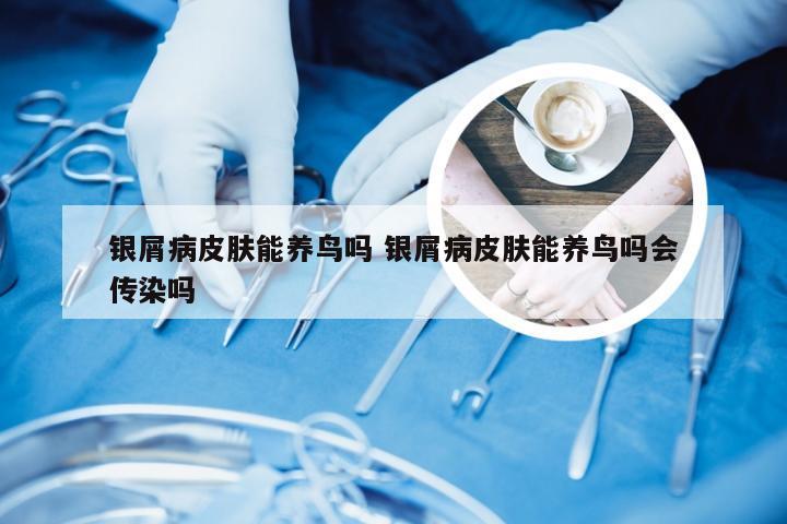 银屑病皮肤能养鸟吗 银屑病皮肤能养鸟吗会传染吗