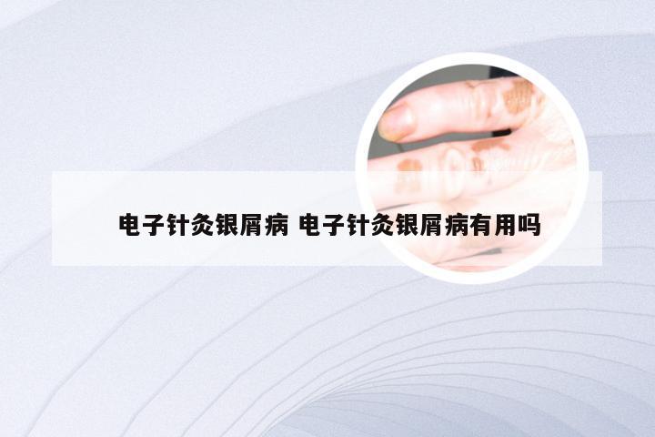 电子针灸银屑病 电子针灸银屑病有用吗