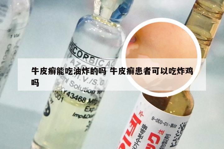 牛皮癣能吃油炸的吗 牛皮癣患者可以吃炸鸡吗
