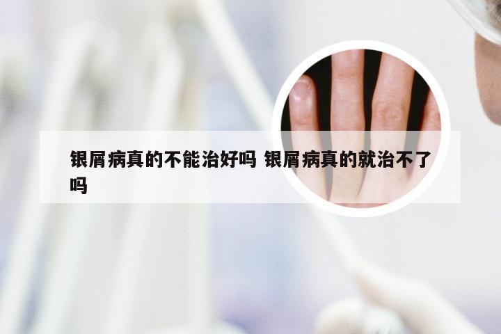 银屑病真的不能治好吗 银屑病真的就治不了吗