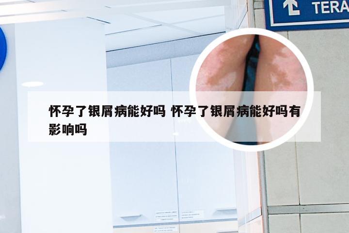 怀孕了银屑病能好吗 怀孕了银屑病能好吗有影响吗