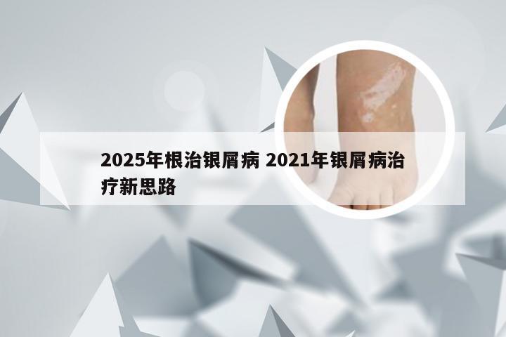 2025年根治银屑病 2021年银屑病治疗新思路