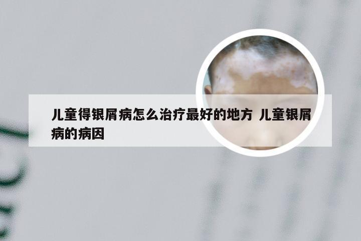 儿童得银屑病怎么治疗最好的地方 儿童银屑病的病因