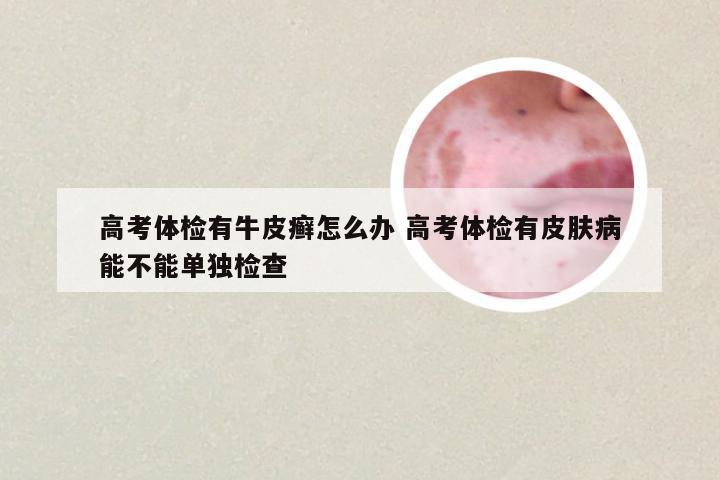 高考体检有牛皮癣怎么办 高考体检有皮肤病能不能单独检查