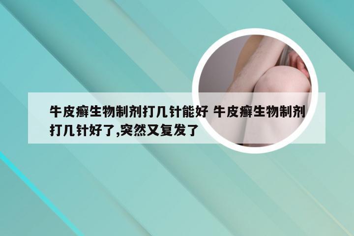 牛皮癣生物制剂打几针能好 牛皮癣生物制剂打几针好了,突然又复发了