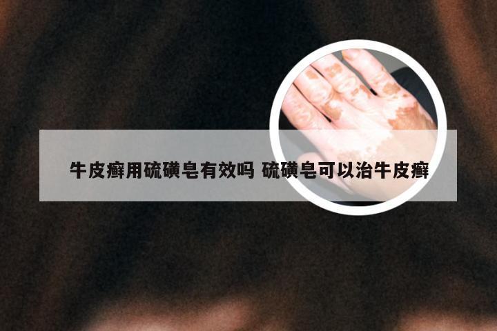 牛皮癣用硫磺皂有效吗 硫磺皂可以治牛皮癣