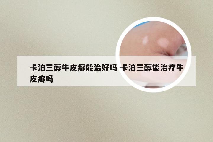 卡泊三醇牛皮癣能治好吗 卡泊三醇能治疗牛皮癣吗