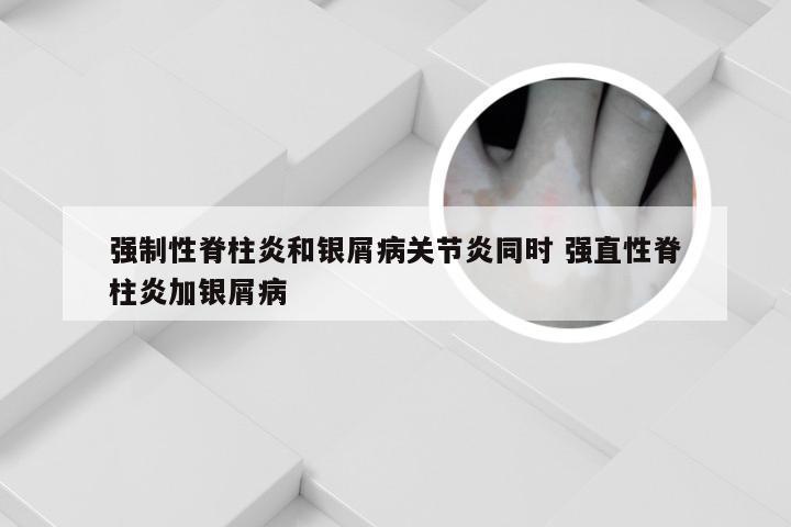 强制性脊柱炎和银屑病关节炎同时 强直性脊柱炎加银屑病