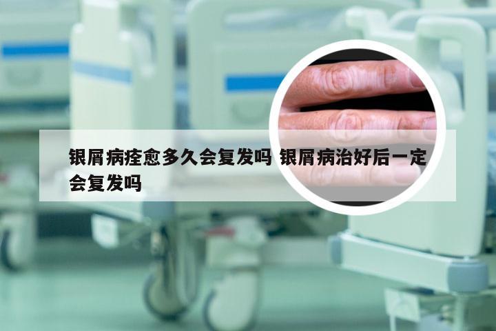 银屑病痊愈多久会复发吗 银屑病治好后一定会复发吗