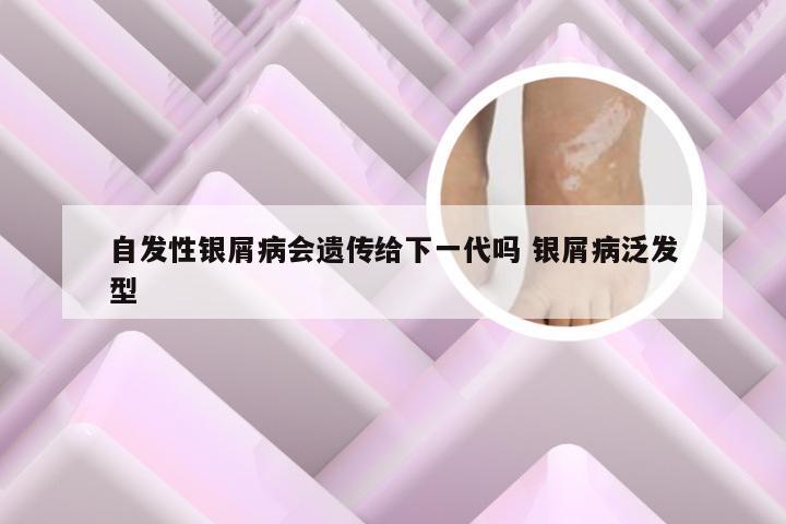 自发性银屑病会遗传给下一代吗 银屑病泛发型