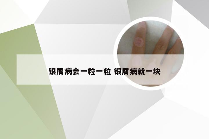 银屑病会一粒一粒 银屑病就一块