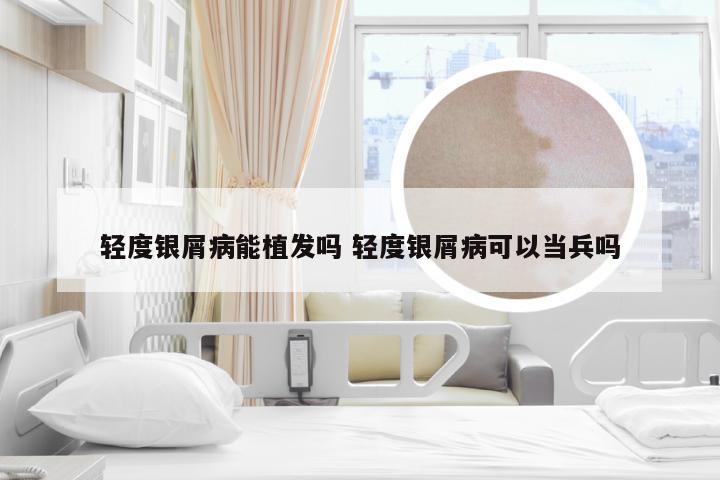 轻度银屑病能植发吗 轻度银屑病可以当兵吗