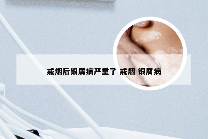 戒烟后银屑病严重了 戒烟 银屑病