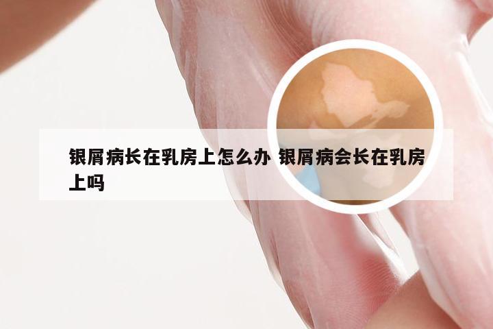 银屑病长在乳房上怎么办 银屑病会长在乳房上吗