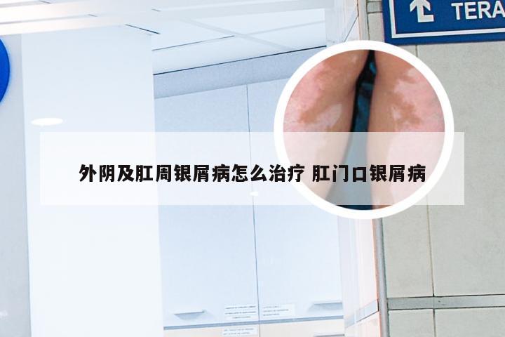 外阴及肛周银屑病怎么治疗 肛门口银屑病