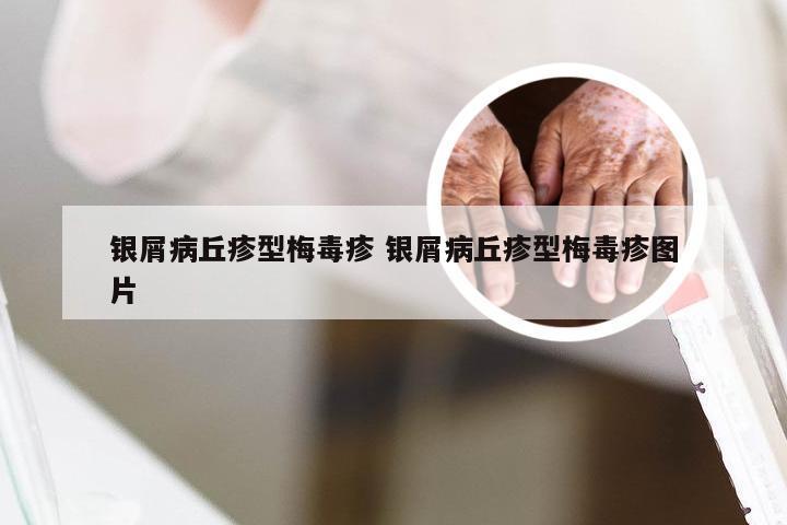 银屑病丘疹型梅毒疹 银屑病丘疹型梅毒疹图片