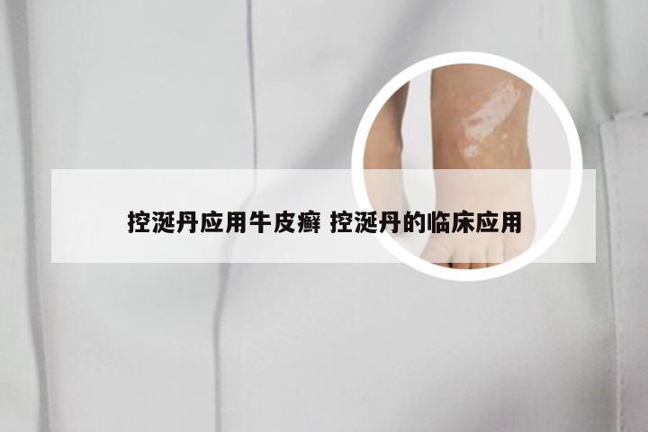 控涎丹应用牛皮癣 控涎丹的临床应用