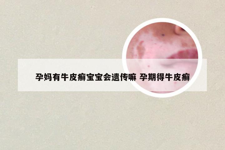 孕妈有牛皮癣宝宝会遗传嘛 孕期得牛皮癣