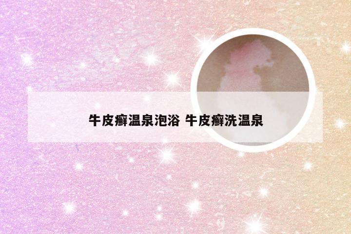 牛皮癣温泉泡浴 牛皮癣洗温泉