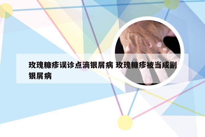 玫瑰糠疹误诊点滴银屑病 玫瑰糠疹被当成副银屑病