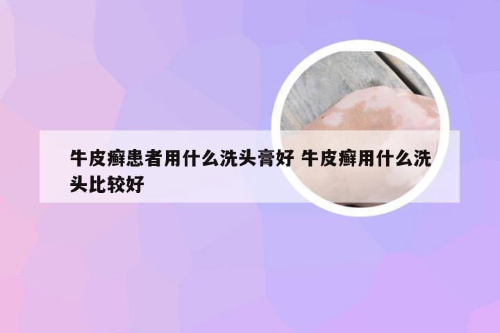 牛皮癣患者用什么洗头膏好 牛皮癣用什么洗头比较好