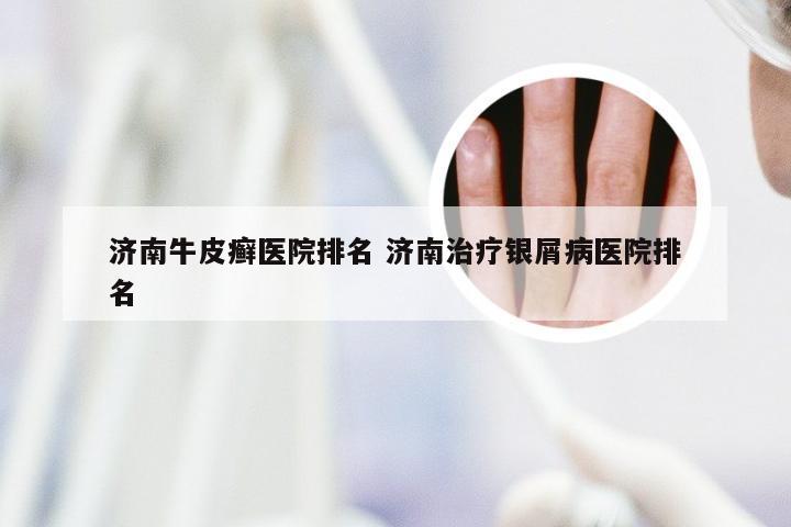 济南牛皮癣医院排名 济南治疗银屑病医院排名