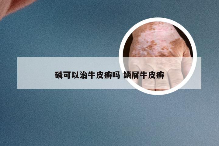 磷可以治牛皮癣吗 鳞屑牛皮癣
