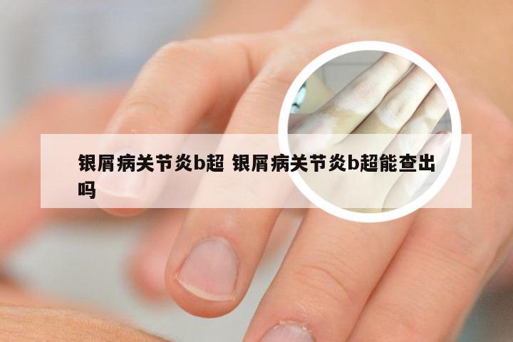 银屑病关节炎b超 银屑病关节炎b超能查出吗