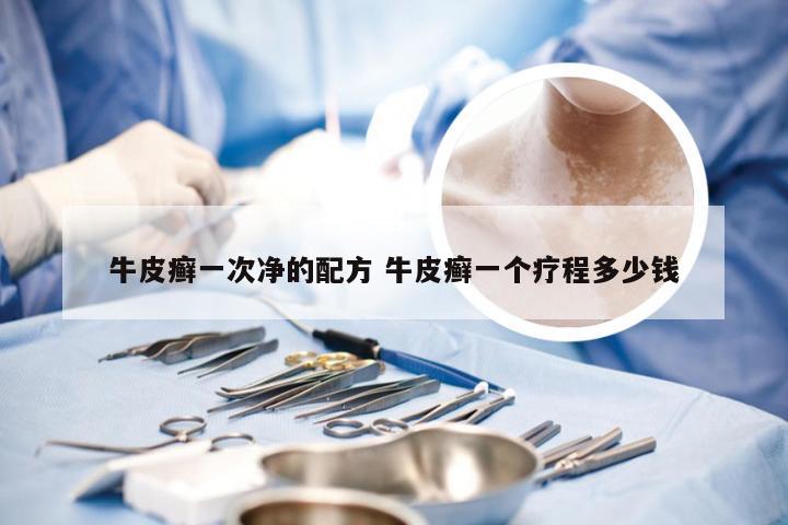 牛皮癣一次净的配方 牛皮癣一个疗程多少钱