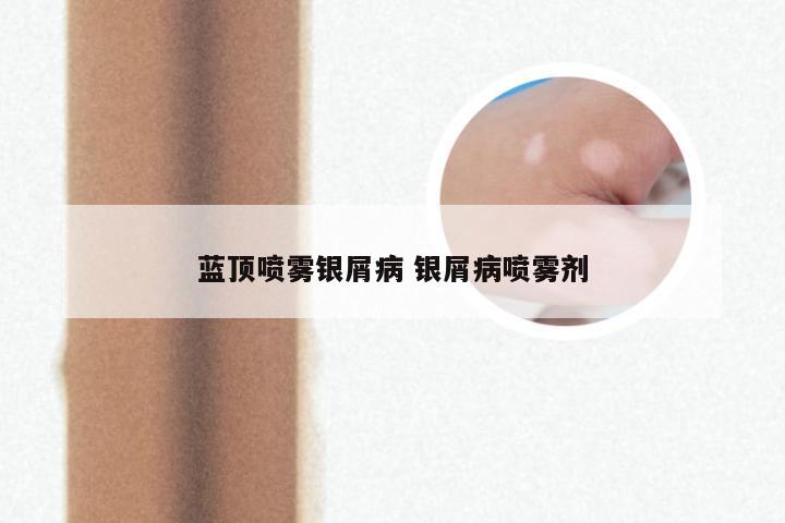 蓝顶喷雾银屑病 银屑病喷雾剂