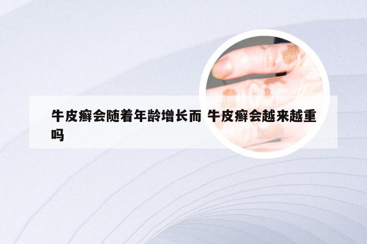牛皮癣会随着年龄增长而 牛皮癣会越来越重吗