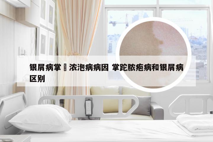 银屑病掌踀浓泡病病因 掌跎脓疱病和银屑病区别