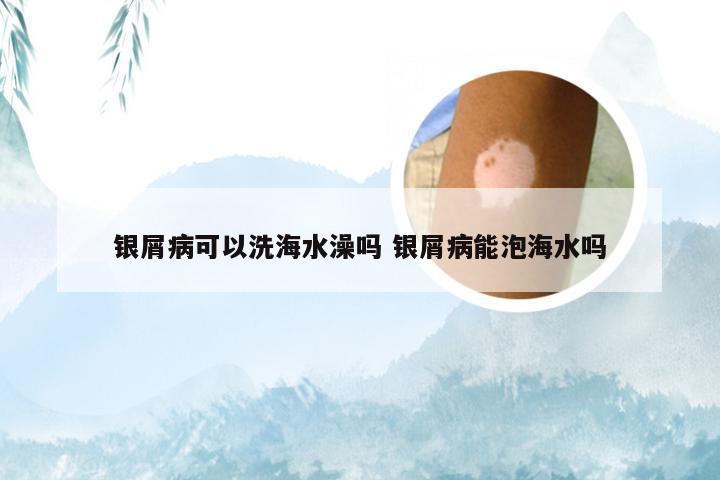 银屑病可以洗海水澡吗 银屑病能泡海水吗