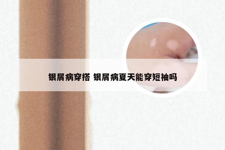 银屑病穿搭 银屑病夏天能穿短袖吗
