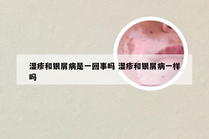 湿疹和银屑病是一回事吗 湿疹和银屑病一样吗