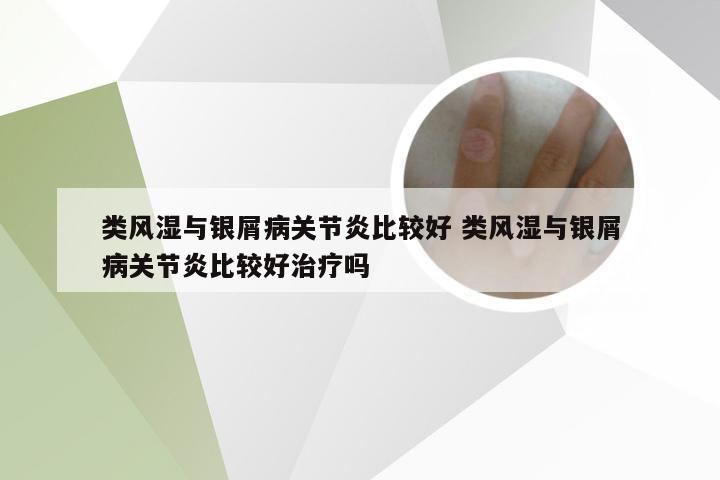 类风湿与银屑病关节炎比较好 类风湿与银屑病关节炎比较好治疗吗